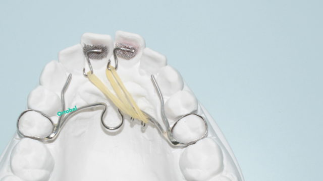 ortodonzia segmentata