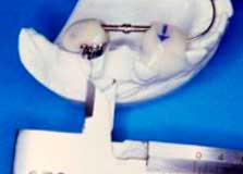 ortodonzia-preprotesica