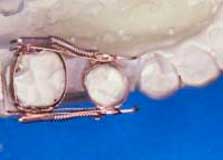 ortodonzia-preprotesica